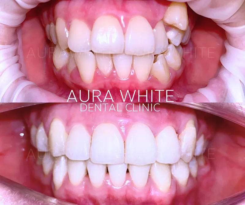 เคสจัดฟันแก้ฟันซ้อนด้านหน้า คลินิกทันตกรรม AuraWhite บางพลี