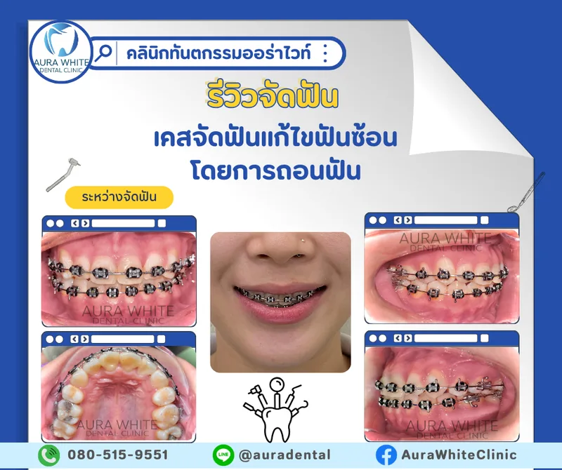 เคสจัดฟันแก้ไขฟันซ้อนเกโดยการถอนฟัน ภาพในช่องปากหลายมุมระหว่างจัดฟัน คลินิกทันตกรรม AuraWhite บางพลี