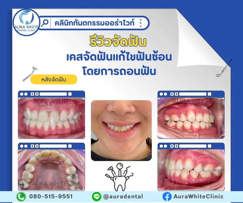 เคสจัดฟันแก้ไขฟันซ้อนเกโดยการถอนฟัน ภาพในช่องปากหลายมุมหลังจัดฟันเสร็จ คลินิกทันตกรรม AuraWhite บางพลี