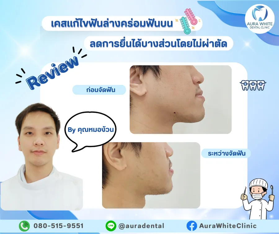 รีวิวเคสจัดฟันหน้าห่าง คลินิกทันตกรรม AuraWhite