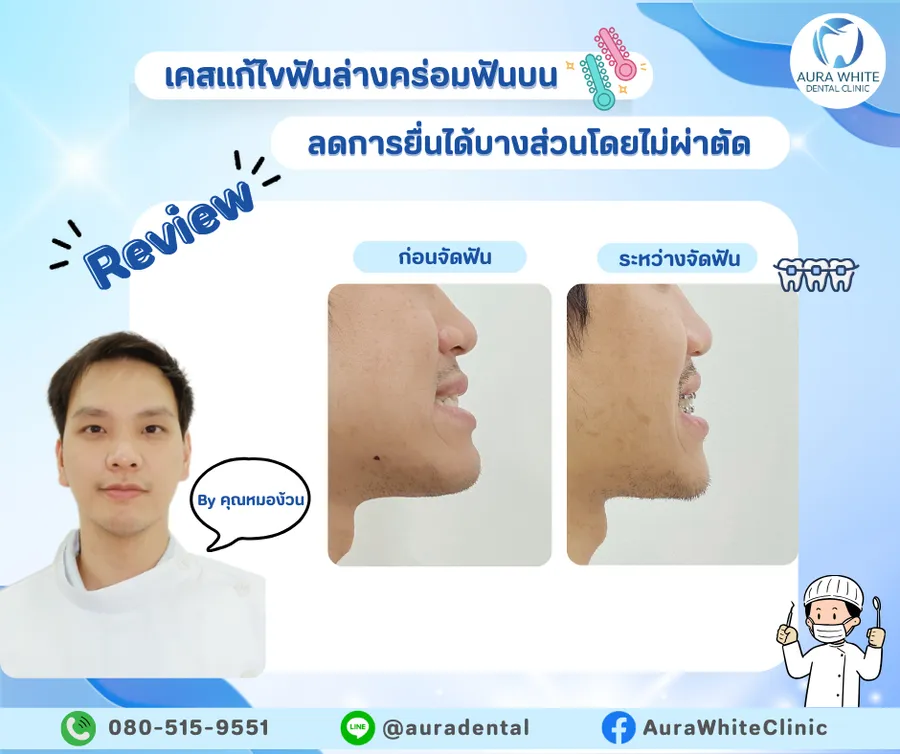 รีวิวการเปลี่ยนแปลงมุมหน้าหลังจัดฟัน AuraWhite