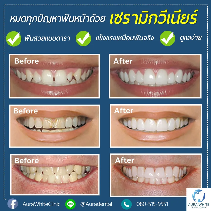 รีวิวเซรามิกวีเนียร์ ก่อนหลัง คลินิกทันตกรรม AuraWhite